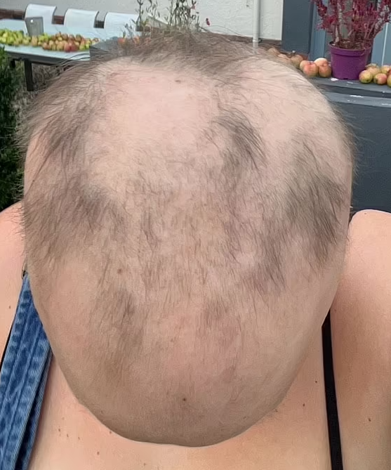 剃光頭後有新頭髮長出。(互聯網)