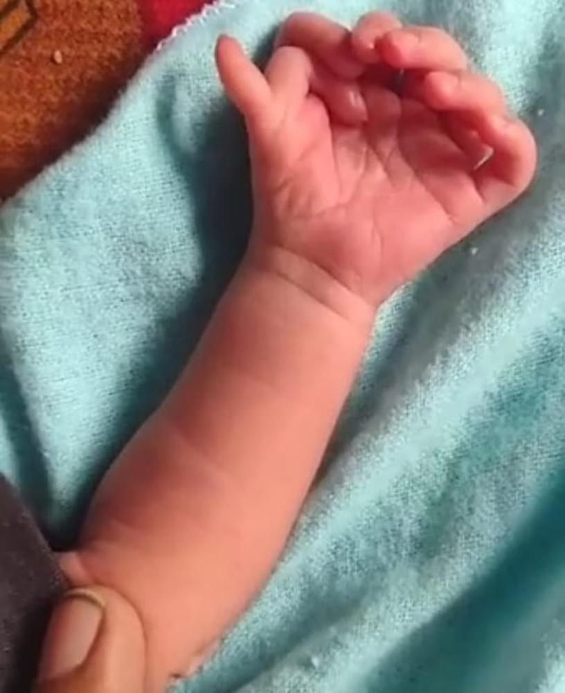 醫生表示:「擁有26根手指腳趾並無任何危害,這是一種基因異常,這個女嬰非常健康。」(X)