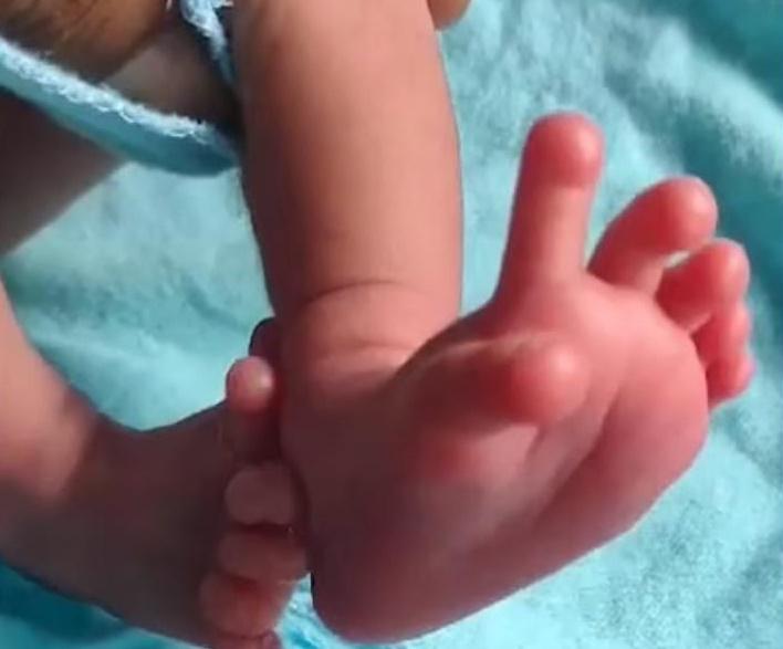 醫生表示:「擁有26根手指腳趾並無任何危害,這是一種基因異常,這個女嬰非常健康。」(X)