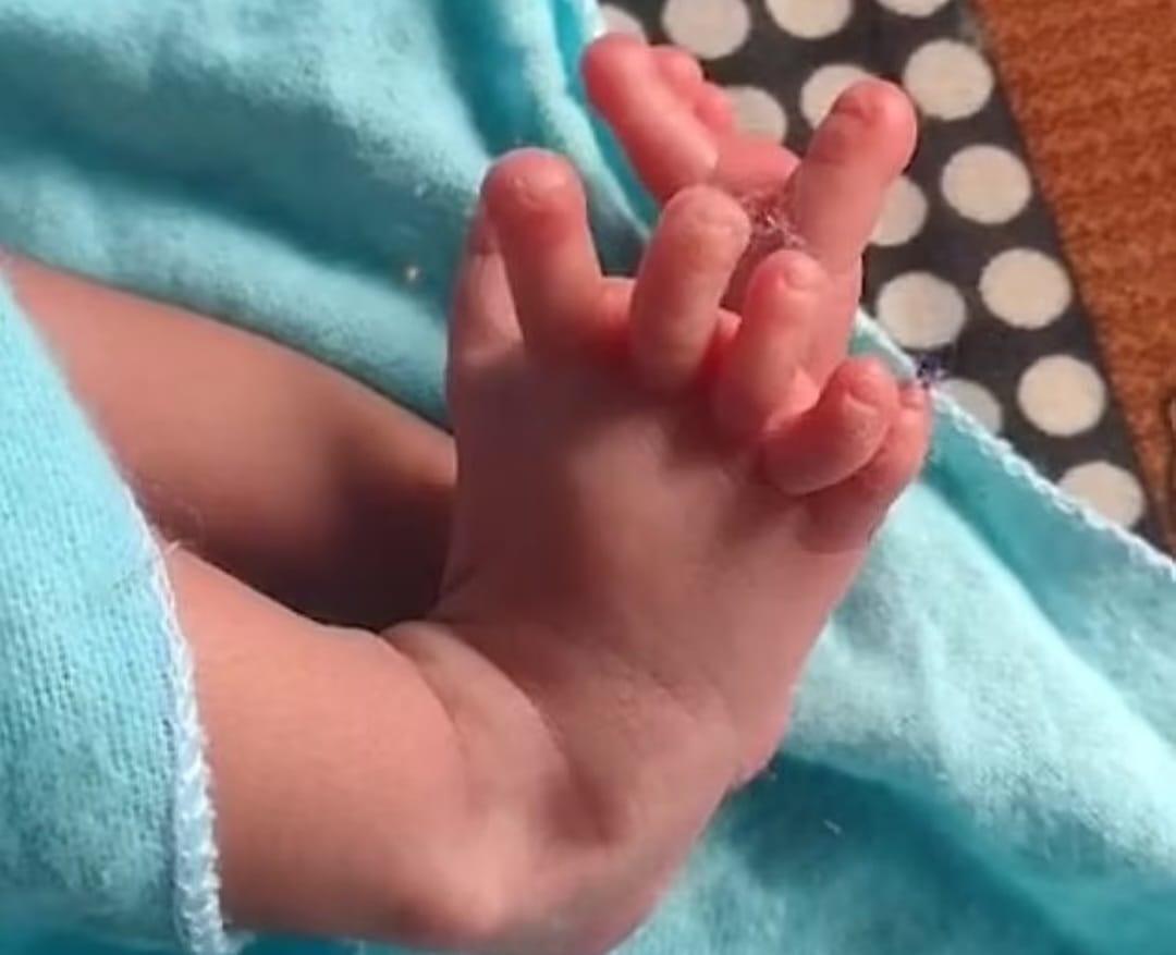 醫生表示:「擁有26根手指腳趾並無任何危害,這是一種基因異常,這個女嬰非常健康。」(X)