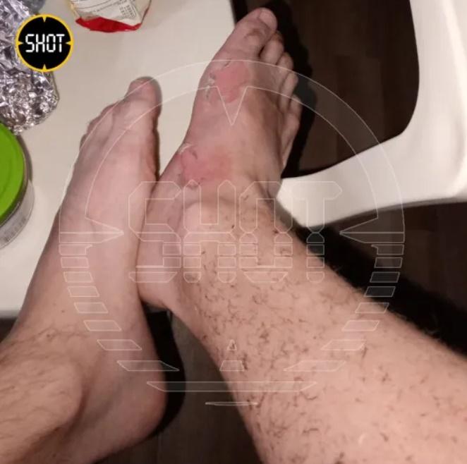 網上相片可見,Smirnov穿著的運動鞋幾乎被燒成碎片,短褲和內褲也被燒焦,胸口及腳的皮膚被燒傷脫皮。(X)