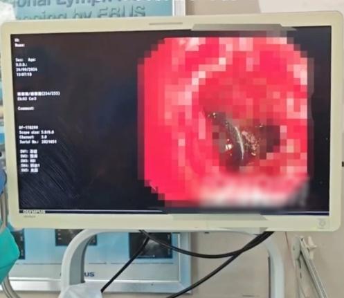 醫生在氣管鏡下看到電腦掃描顯示,異物所在支氣管幾乎完全閉塞,僅見一針眼大小孔道間斷冒出膿液。(微博)