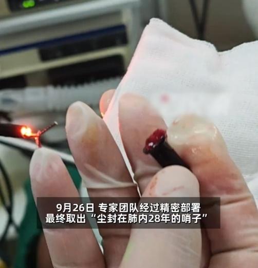 男子自述8歲時曾誤吸過一枚哨子。(微博)