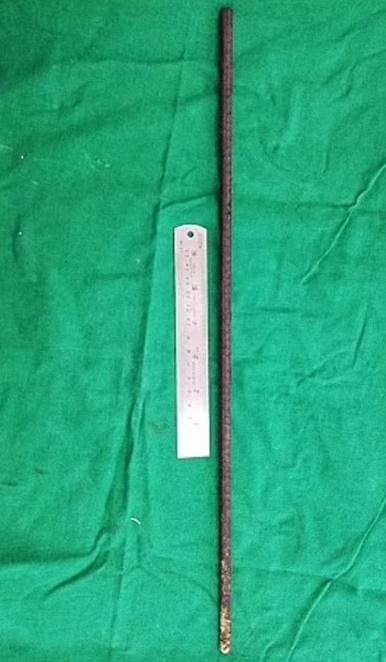 醫生移除一支插進婦人體內長達60厘米的生鏽鐵棍。(網上圖片)