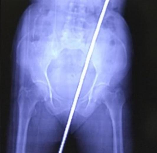 X光片。(網上圖片)