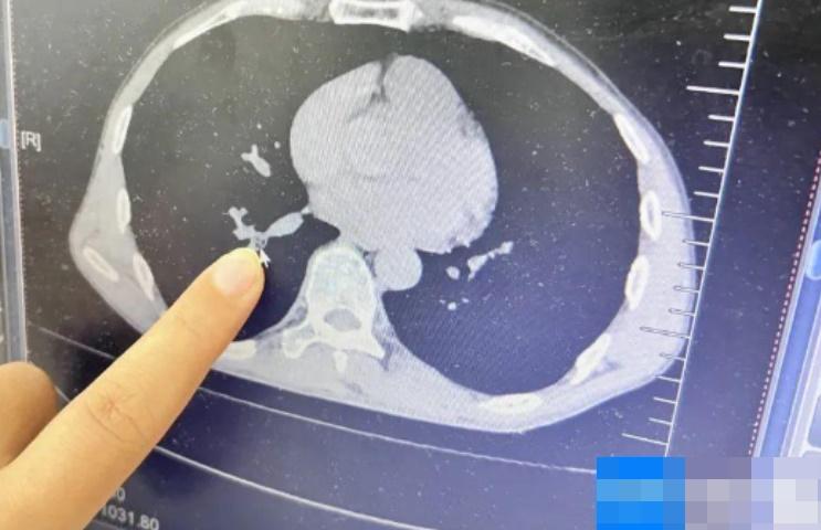 醫生為病者做胸部CT檢查,發現患者右下葉外後基底段有一塊陰影,結合病史,考慮是有異物。(微博)