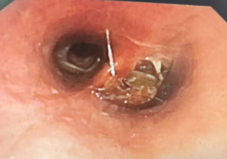 醫生指,在支氣管吸了周圍的痰後,暴露出了異物,就是一只曱甴。(微博)