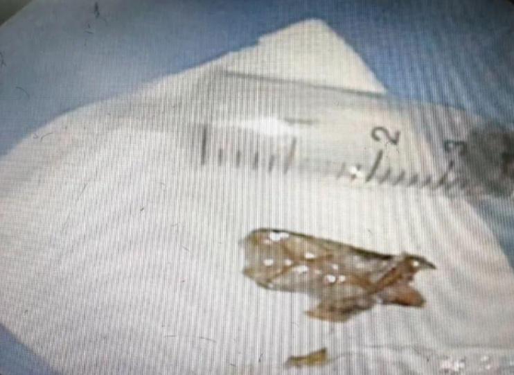 醫生在病人的支氣管裡取出一隻曱甴。(微博)