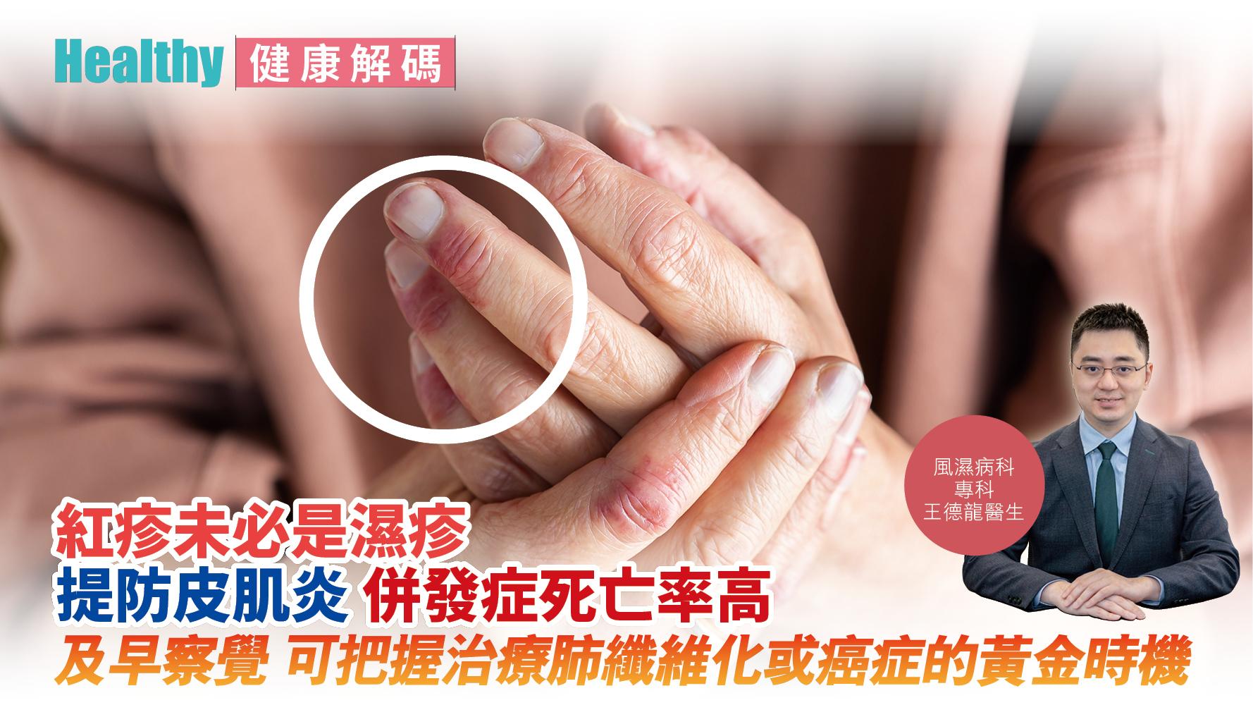 健康解碼|紅疹未必是濕疹 提防皮肌炎 併發症死亡率高 及早察覺 可把握治療肺纖維化或癌症的黃金時機