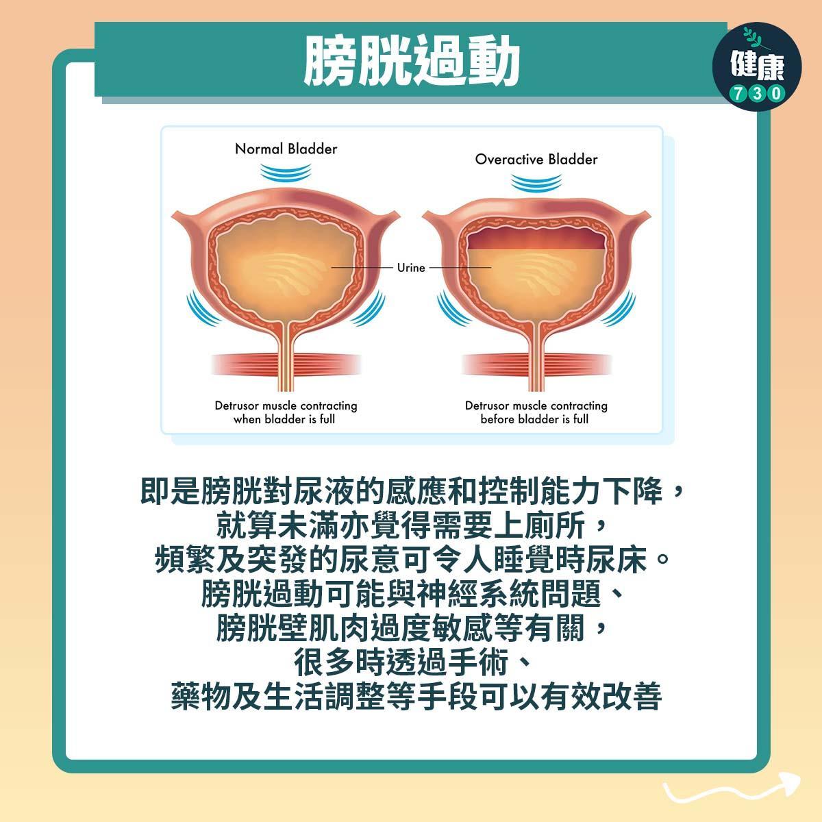 成年人尿床原因丨膀胱過動(am730製圖)