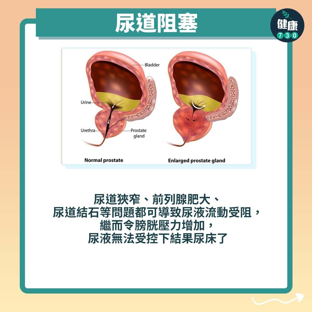 成年人尿床原因丨尿道阻塞(am730製圖)