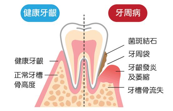 牙周病