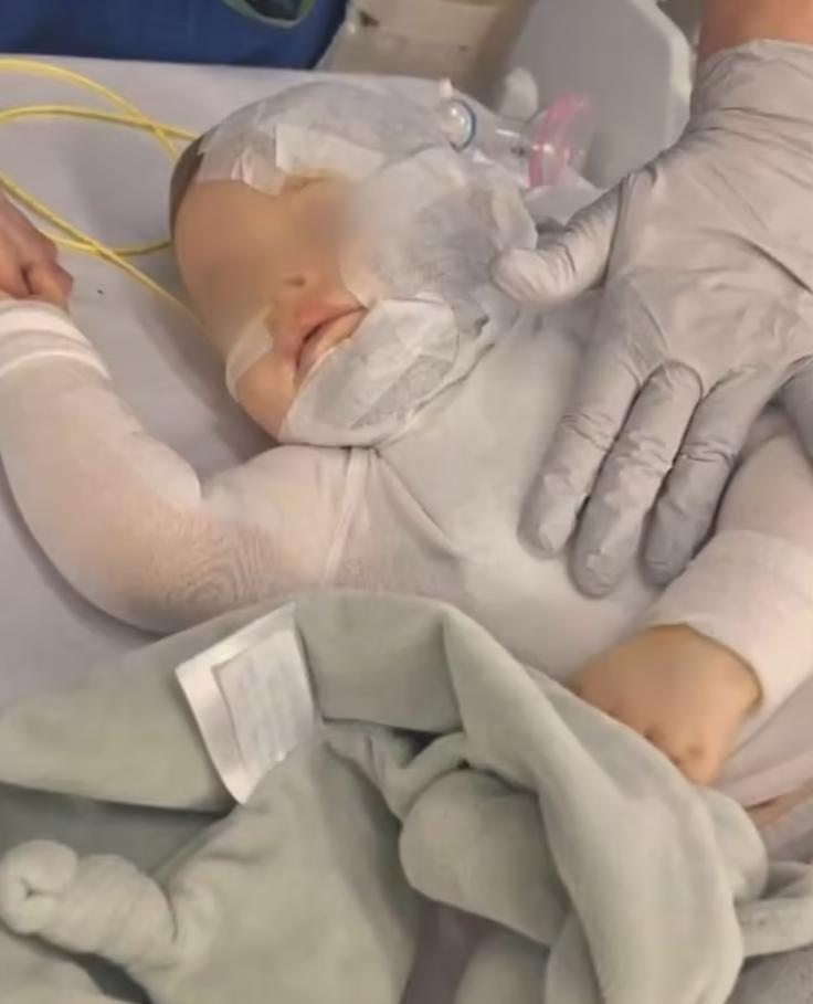 盧卡的面部、上身和手臂嚴重燒傷,並已做了4次手術,目前已可拆除繃帶,但仍需進一步治療,母親稱男嬰或需數年才可康復