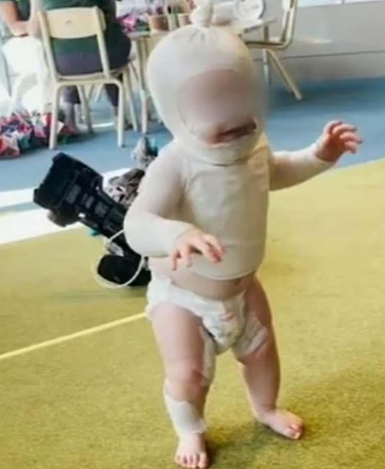 盧卡的面部、上身和手臂嚴重燒傷,並已做了4次手術,目前已可拆除繃帶,但仍需進一步治療,母親稱男嬰或需數年才可康復