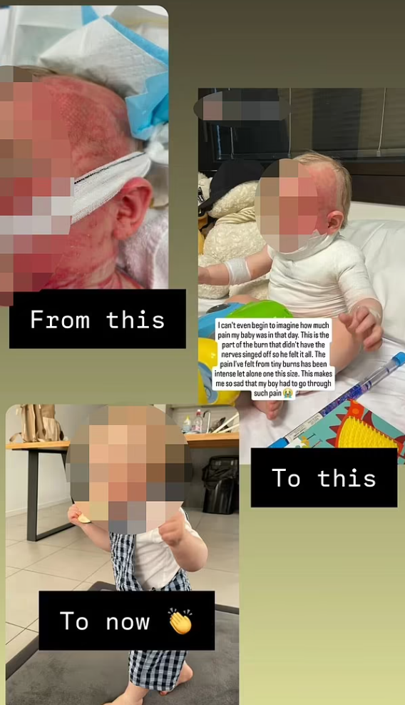 盧卡的面部、上身和手臂嚴重燒傷,並已做了4次手術,目前已可拆除繃帶,但仍需進一步治療,母親稱男嬰或需數年才可康復