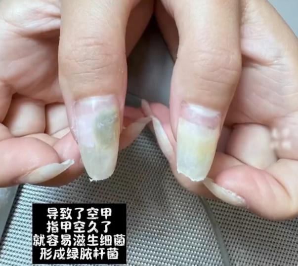 她十指空甲,其中2隻指頭甲層還長有「綠膿桿菌」。(微博)