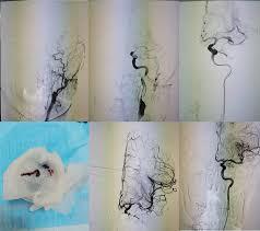 王先生確診急性缺血性腦梗死。(微博)