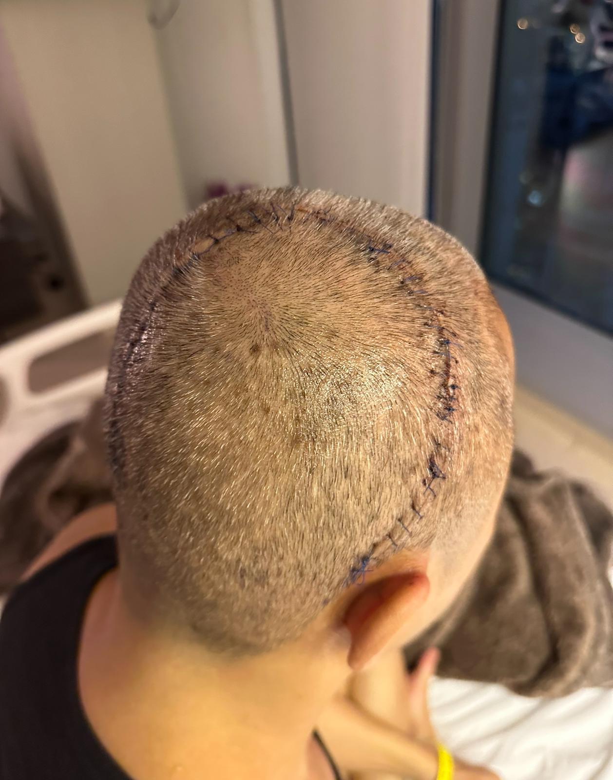 剛動完手術的傑仔,頭上留下長長的疤。