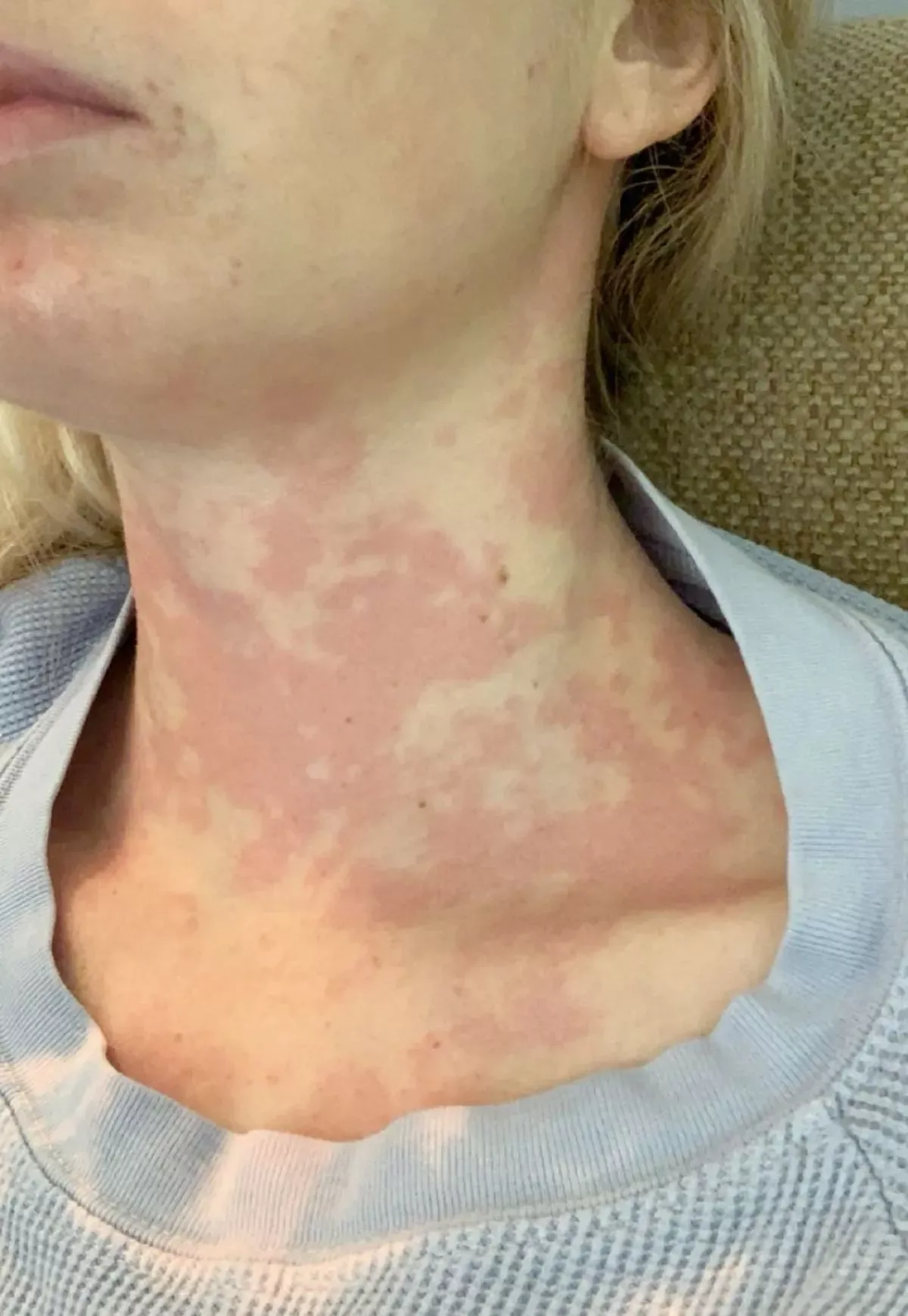 昆妮 (Caroline Cray Quinn) 曾因接吻而出現症狀。