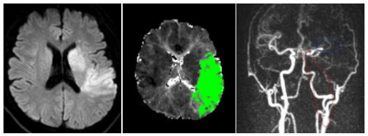 王先生確診急性缺血性腦梗死。(微博)