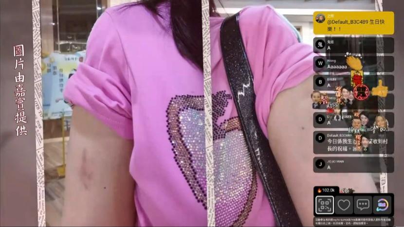 陳雅倫展示懷疑被鬼捏瘀的圖片。