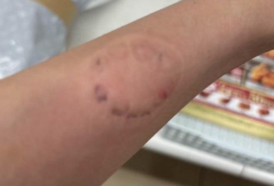 梁果琳當日被搶匪狠咬左手臂,留下深深的牙齒印。(互聯網)