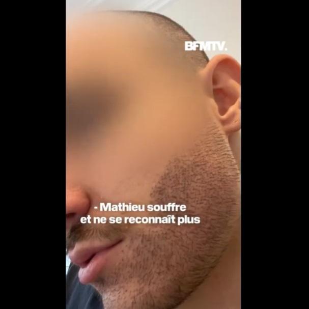 手術後鬍鬚不正常生長。(互聯網)