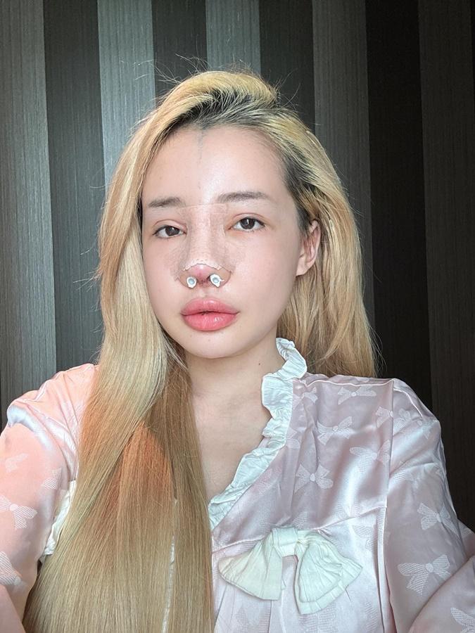 Ngan98日前剛公開自己最新一次整容手術後的樣子。(X)