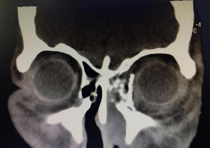 經過近4個小時的緊張手術,眼球成功復位到左眼眶內,並修覆了眼眶爆裂性骨折。(微博)