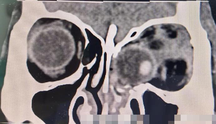 經檢查後,發現病者的左眼球脫位,並嵌頓於鼻腔內,情況十分危急。(微博)