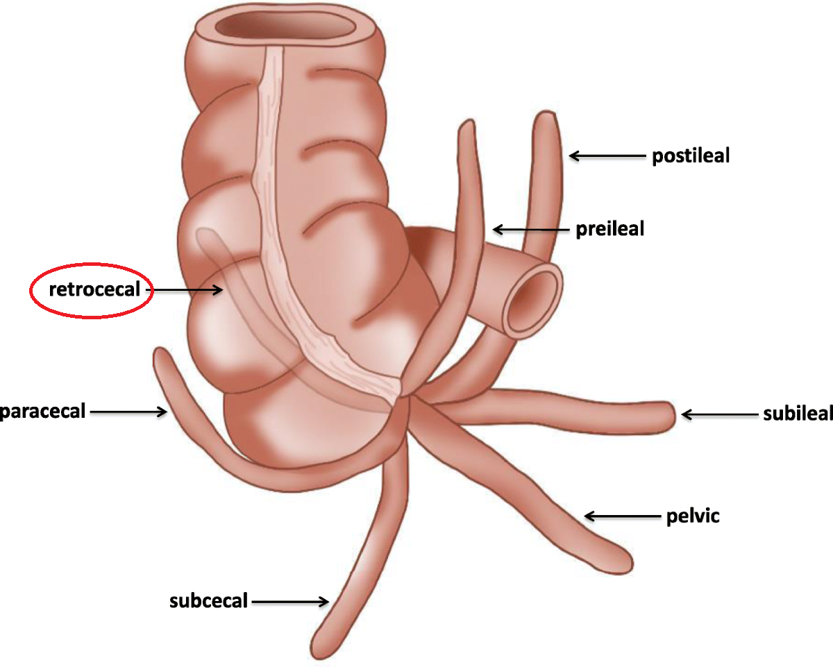 據報女童患的是「急性後盲腸炎」,發炎位置位於盲腸後方(紅圈)。(互聯網)