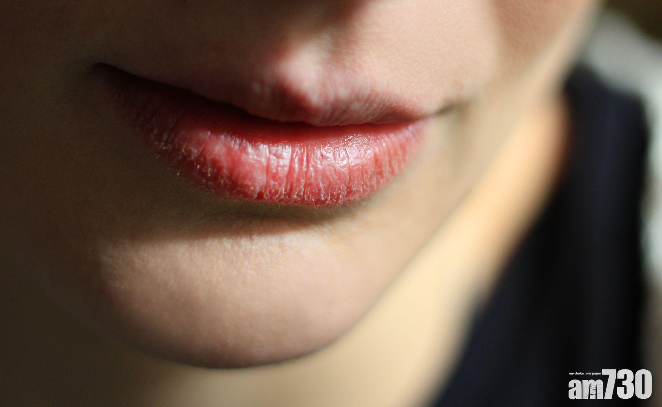 嘴唇乾燥甩皮是女生冬天常見的問題。