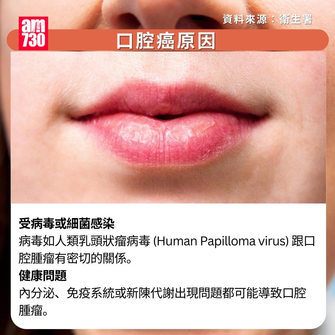 口腔癌原因/症狀/治療/預防方法|原因(am730製圖)