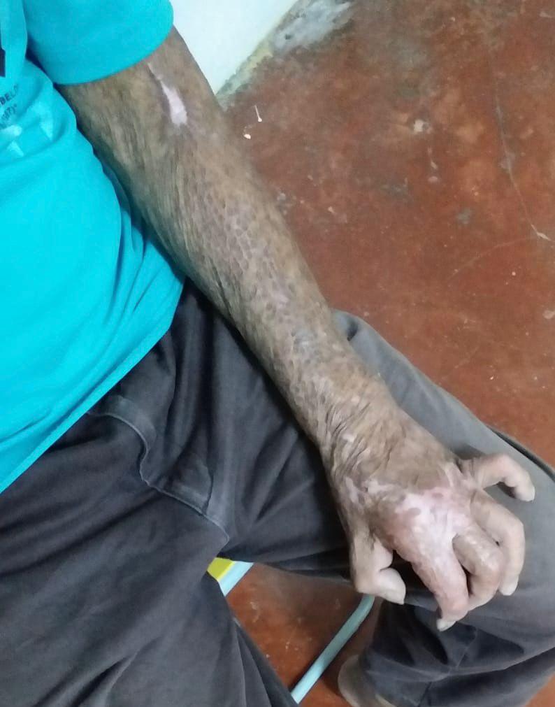 一直跟進李伯狀況的民建聯立法會議員葛珮帆透露對方完全康復之日仍遙遙無期,今年7月再次中風入院,情況一度危殆,幸好治療後終於可以出院回家休養。(葛珮帆FB)