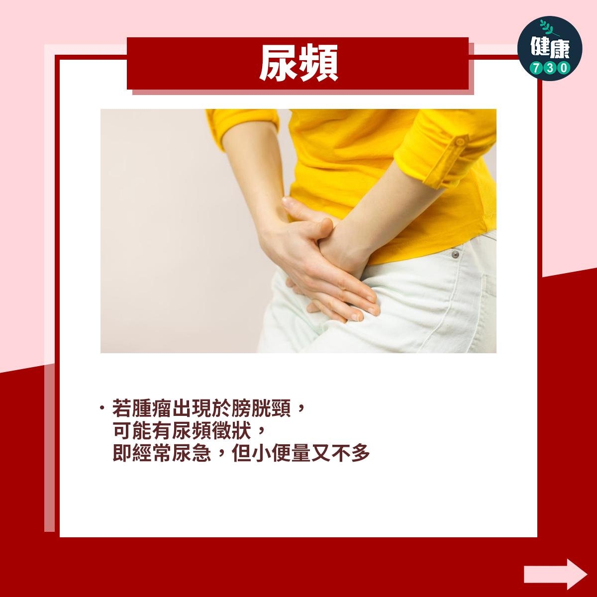 膀胱癌症狀|尿頻(am730製圖)