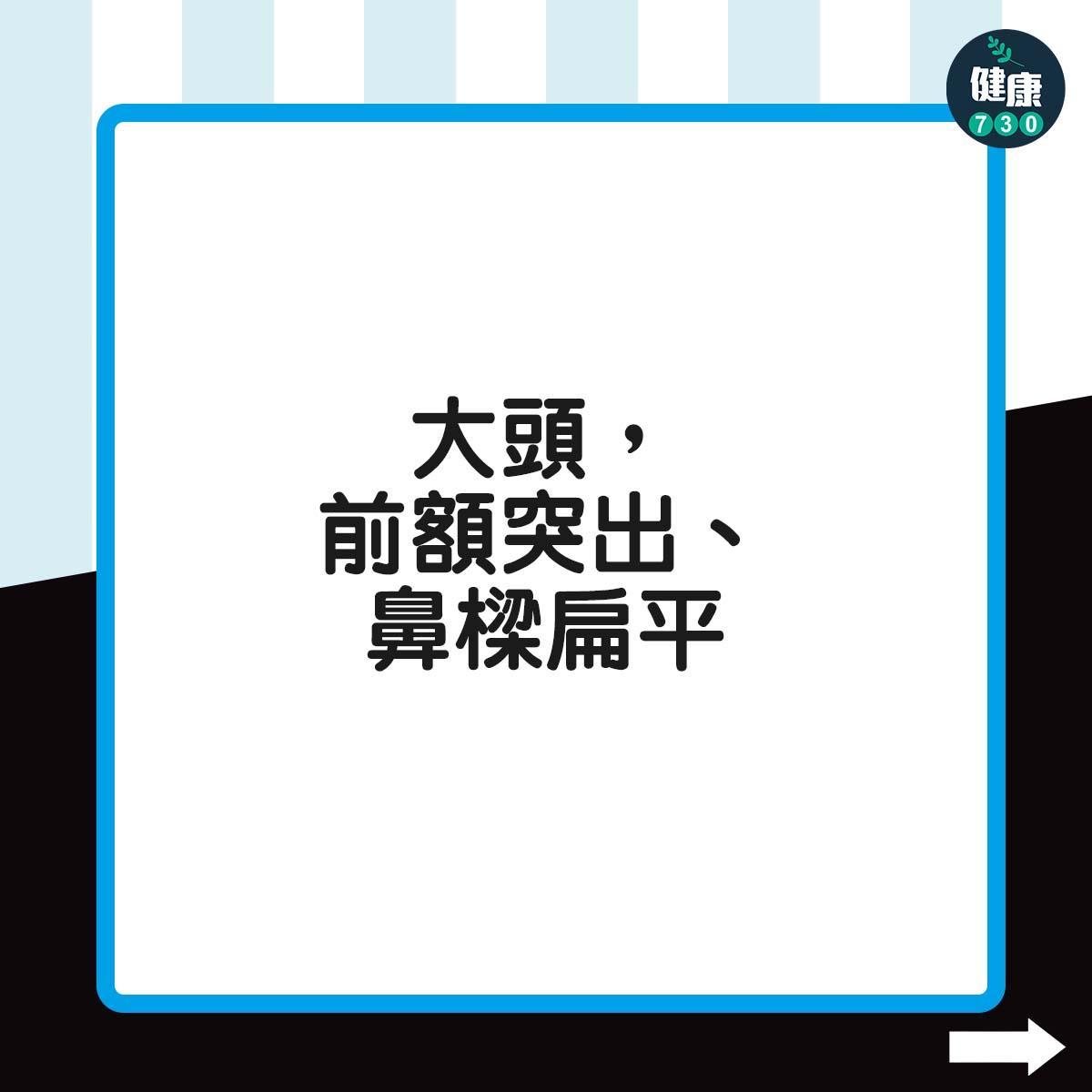 侏儒症症狀|大頭,前額突出、鼻樑扁平(am730製圖)