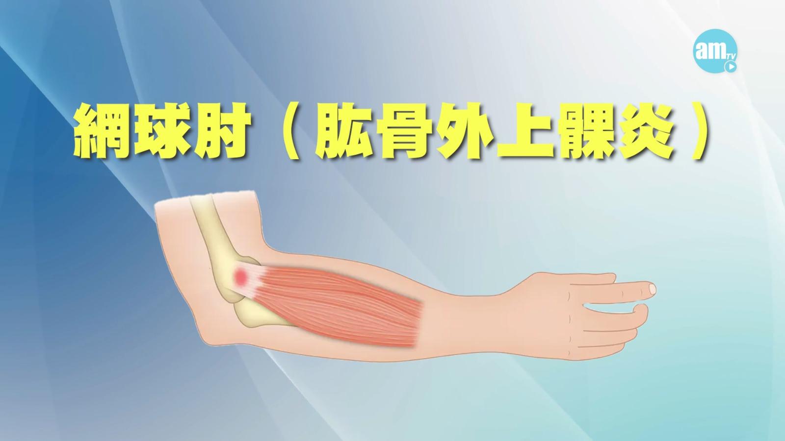 網球肘又稱肱骨外上髁炎,通常發生在手肘外側,會造成手肘外側的疼痛。
