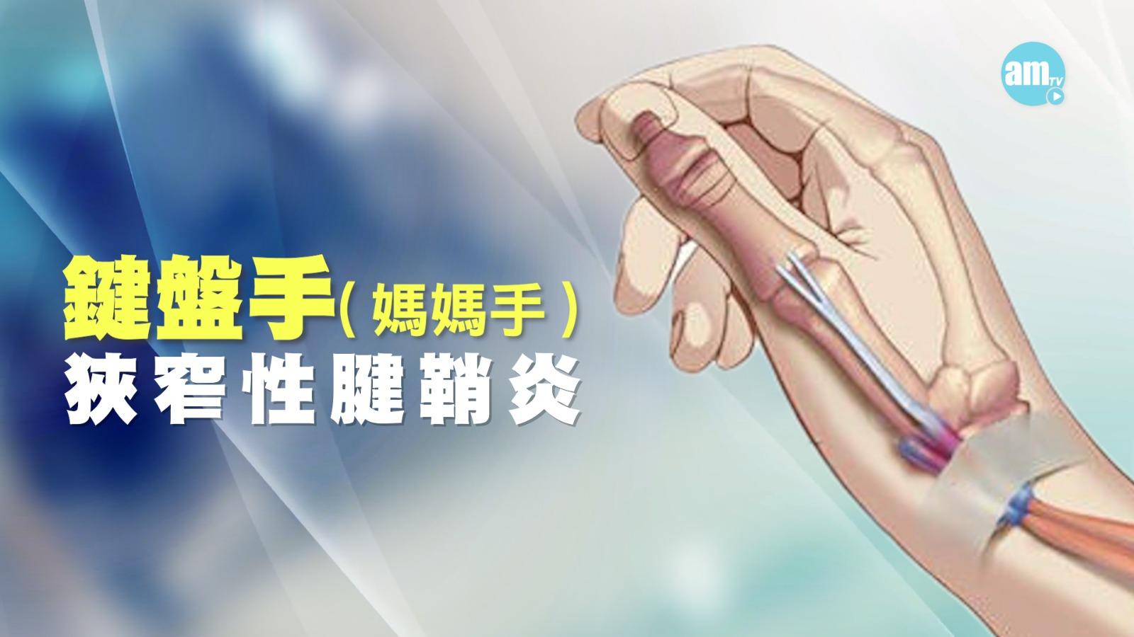 鍵盤手,醫學上稱為狹窄性腱鞘炎,是一種慢性勞損疾病,是由於長時間重複使用鍵盤,導致手部腱鞘發炎,進而引發疼痛、痠脹和乏力感。