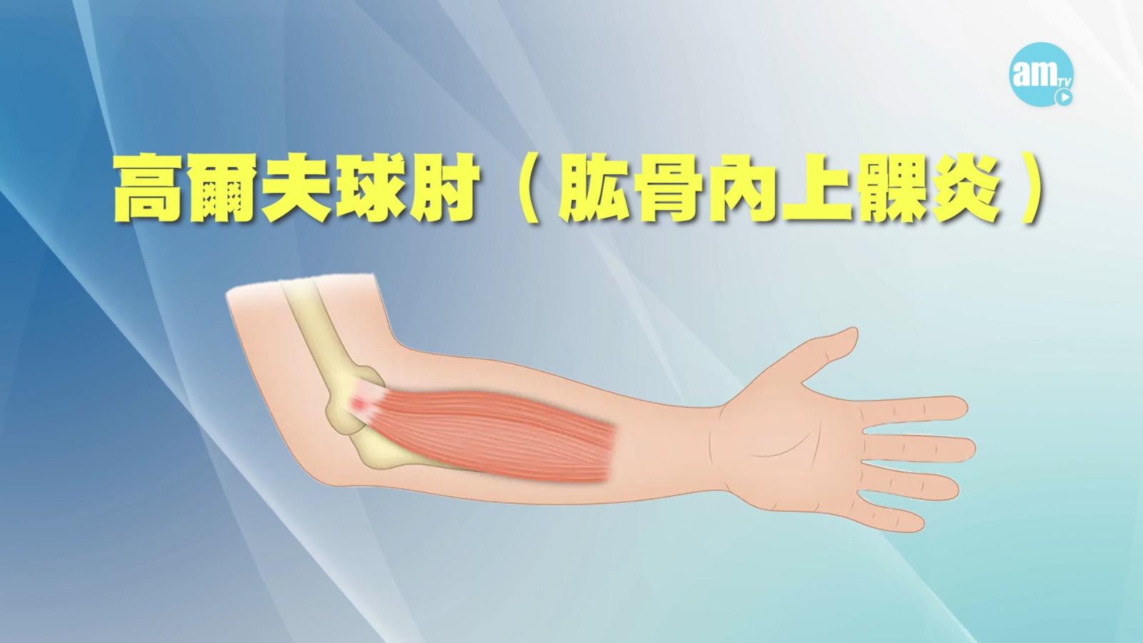 高爾夫球肘名為肱骨内上髁炎,則是手肘內側的肌腱發炎,疼痛感會集中在手肘內側。