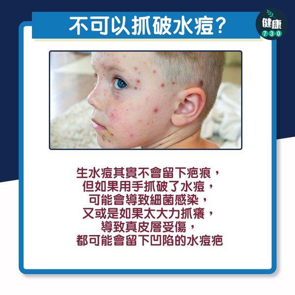 水痘一生一次?拆解3大迷思丨不可以抓破水痘?(am730製圖)
