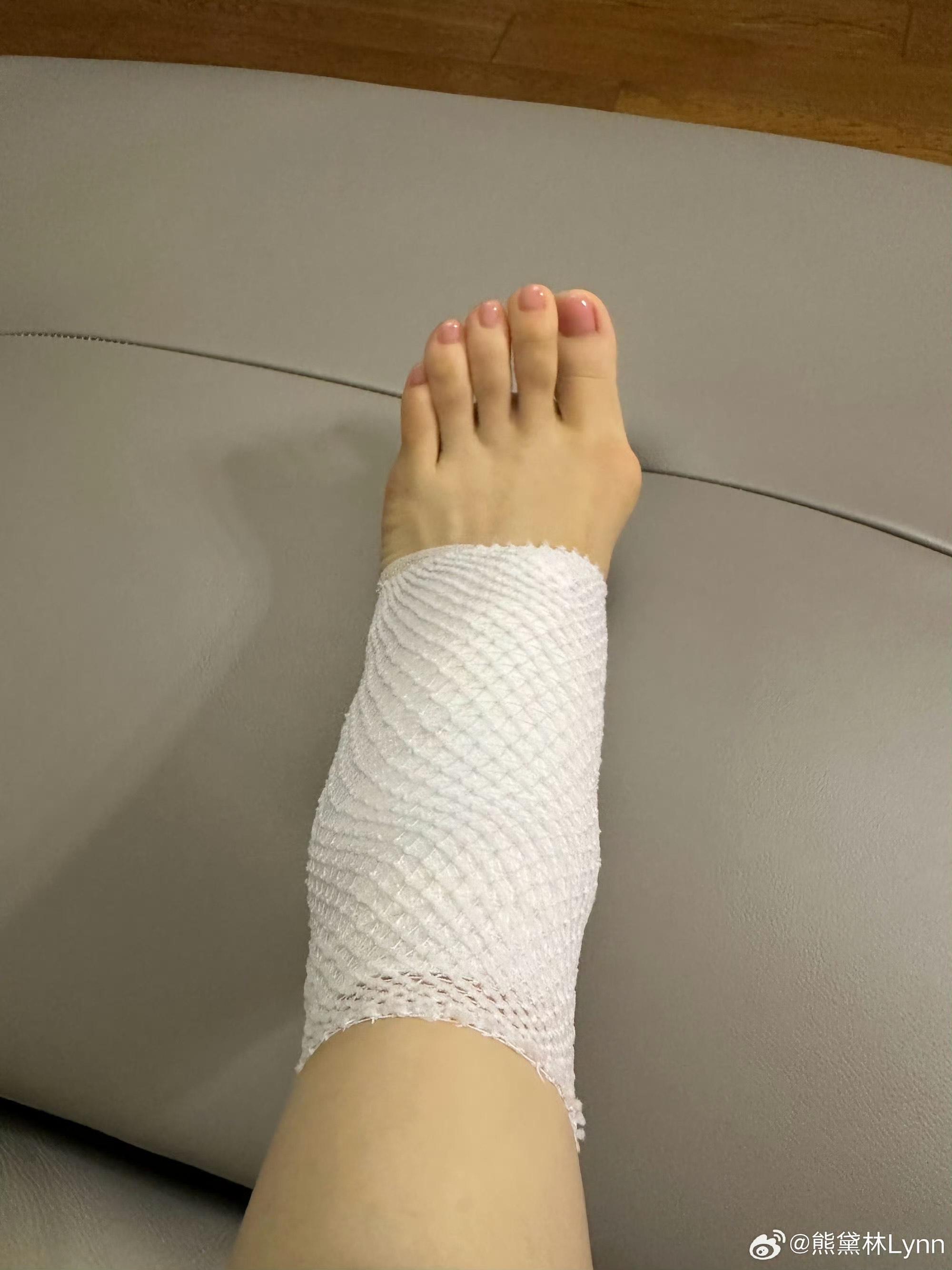 網民發現熊黛林有嚴重拇趾外翻情況,建議做手術。