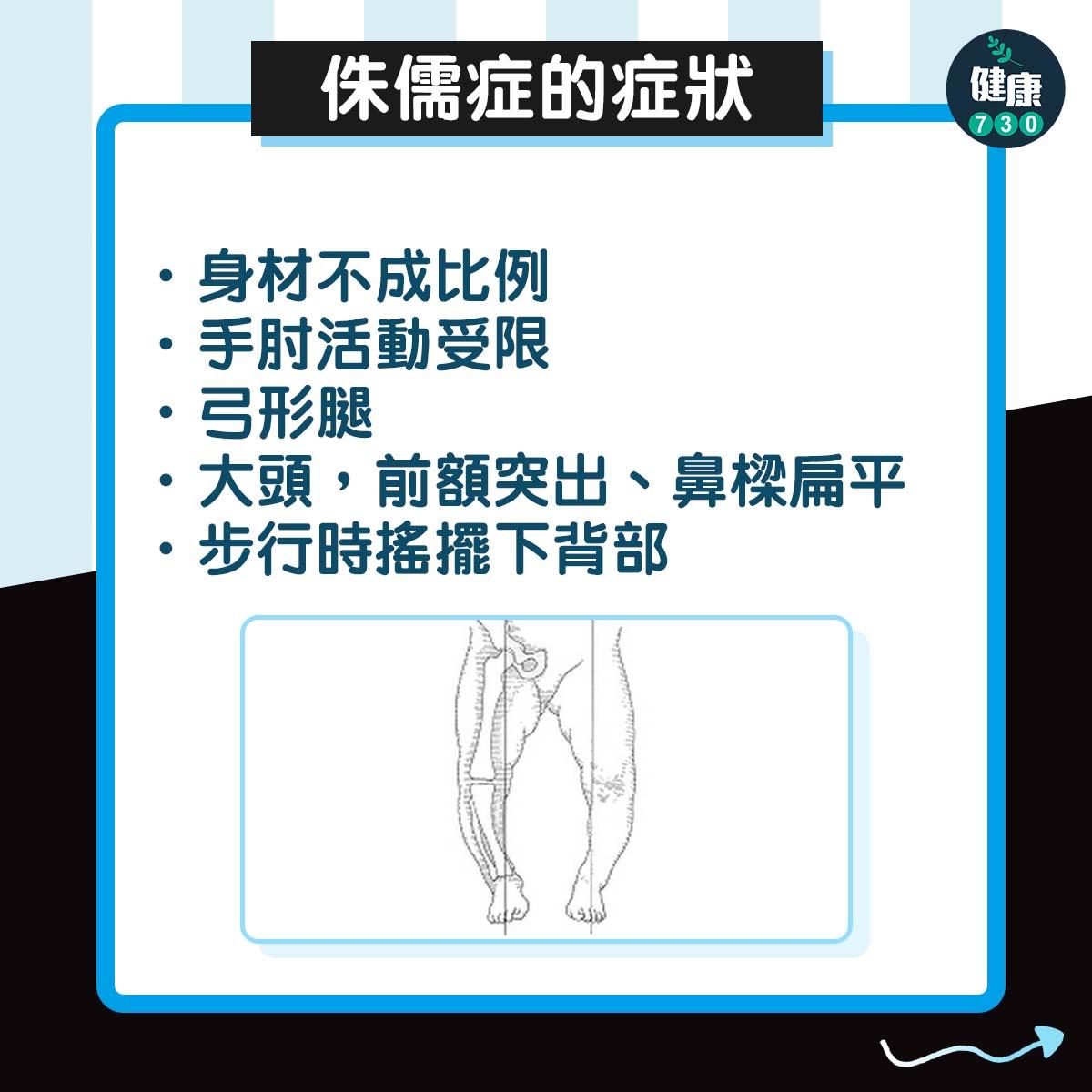 侏儒症|美斯11歲確診生長激素缺乏症,症狀包括弓形腿(am730製圖)