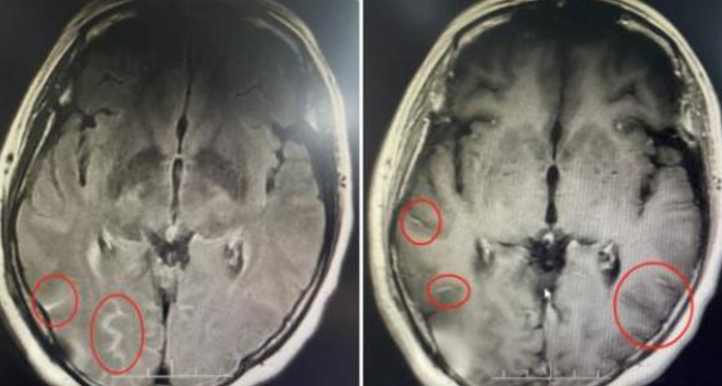 廣東河源的51歲梅姨(化名)近日出現劇烈頭痛,每天吃六顆止痛藥還是頂不住,就醫後被診斷出患有隱球菌腦膜炎,更是與她每天到街市買餸有關。