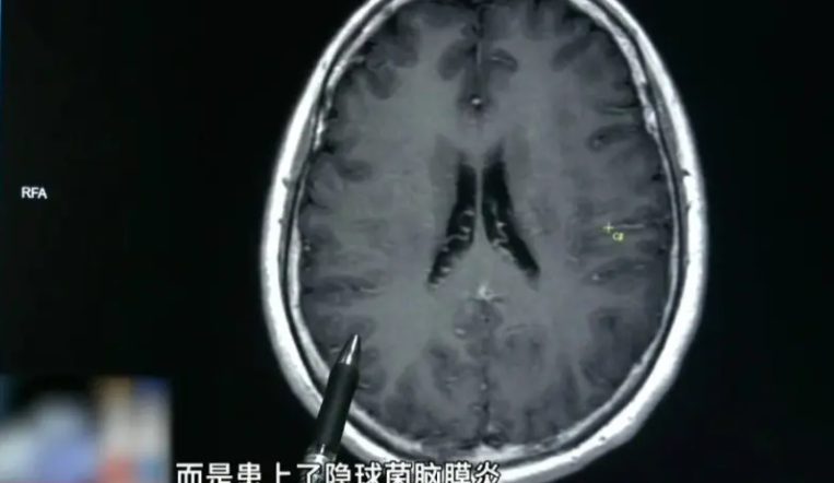 廣東河源的51歲梅姨(化名)近日出現劇烈頭痛,每天吃六顆止痛藥還是頂不住,就醫後被診斷出患有隱球菌腦膜炎,更是與她每天到街市買餸有關。