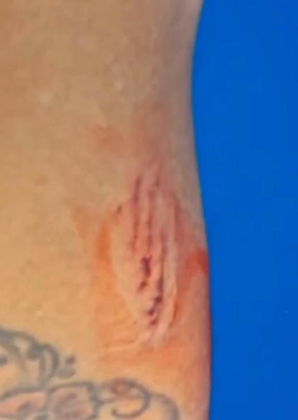 可以看到她的腿上流著血,小腿清晰可見兩排鯊魚牙印。(IG)