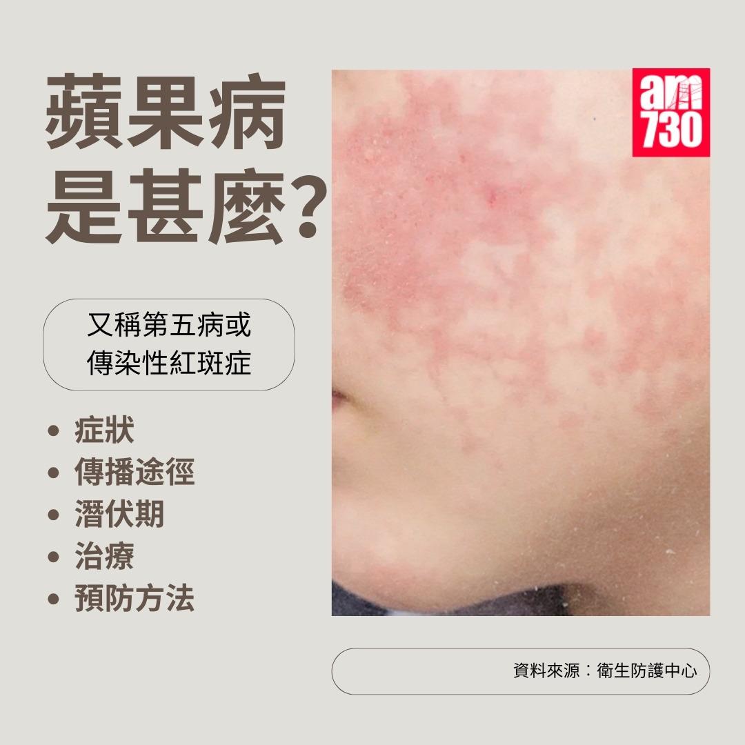 蘋果病|又稱第五病或傳染性紅斑症(am730製圖)