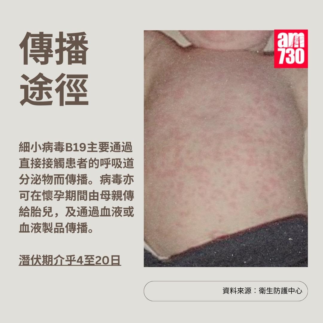 蘋果病|傳播途徑及潛伏期(am730製圖)