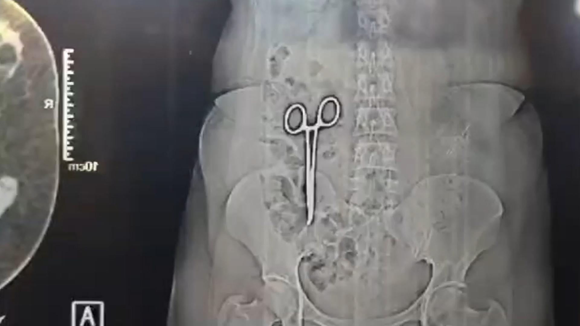 印度婦人的胃部X光照,清潔可見一把剪刀。