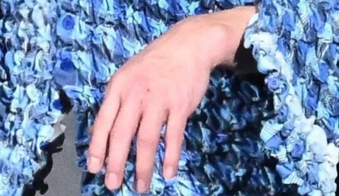 郭富城之後忍痛上台繼續演出,手部輕微擦傷。