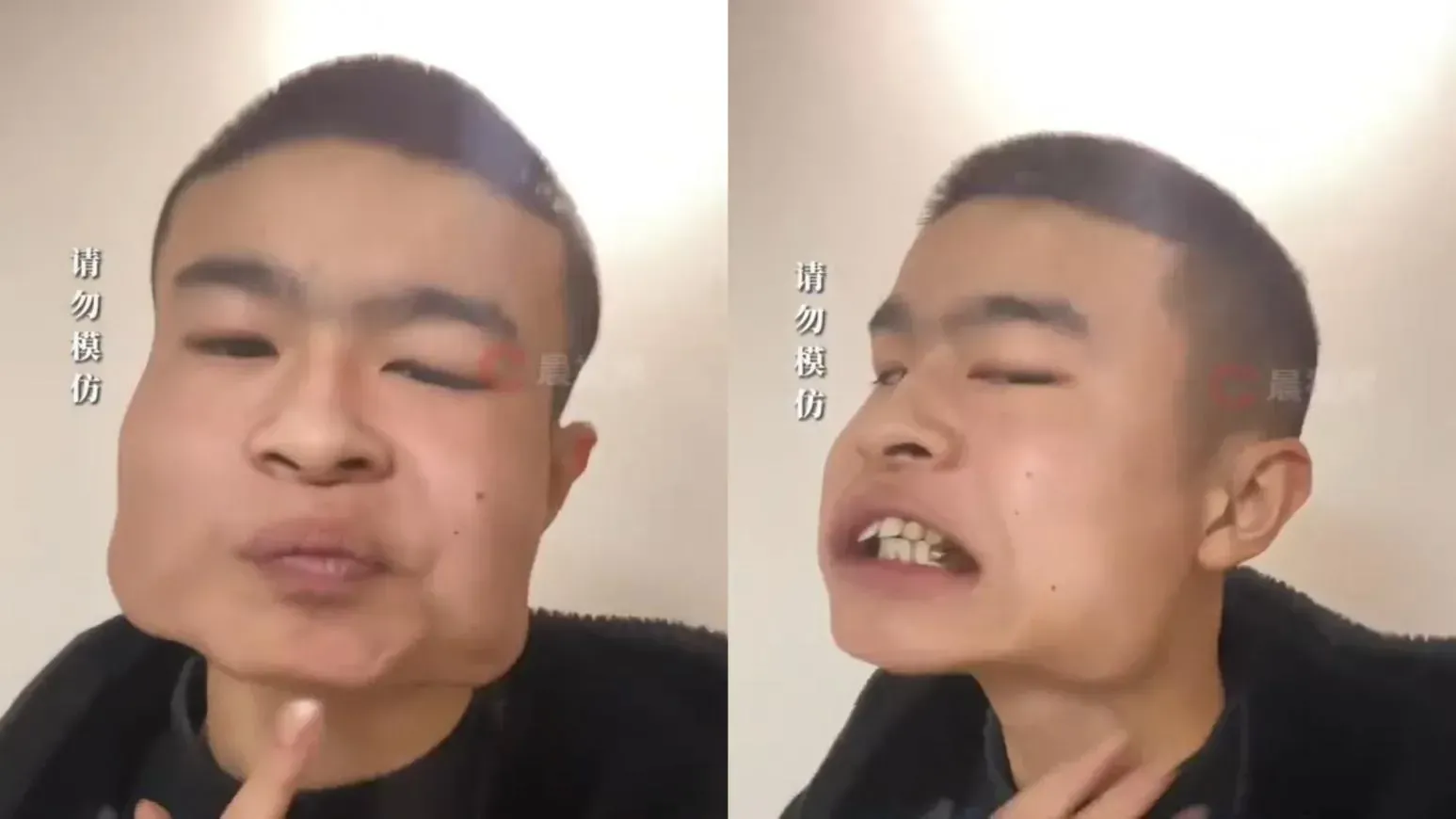 男子自稱嚼檳榔8年瓜子臉變「方塊臉」。(瀟湘晨報圖片)